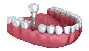 Dental Implants - Rockaway NJ - JC Dental