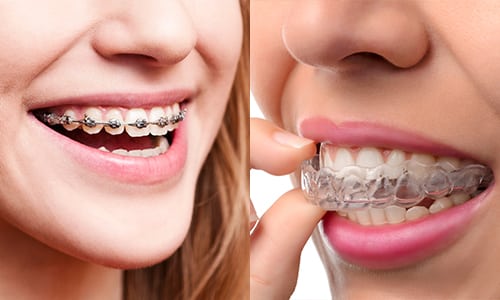 The Great Debate Clear Aligners Vs Traditional Braces